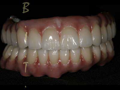 Dental Implants